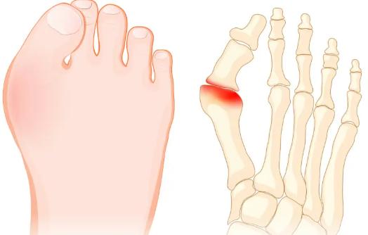 一直以为脚只是不好看，没想到居然是种病!